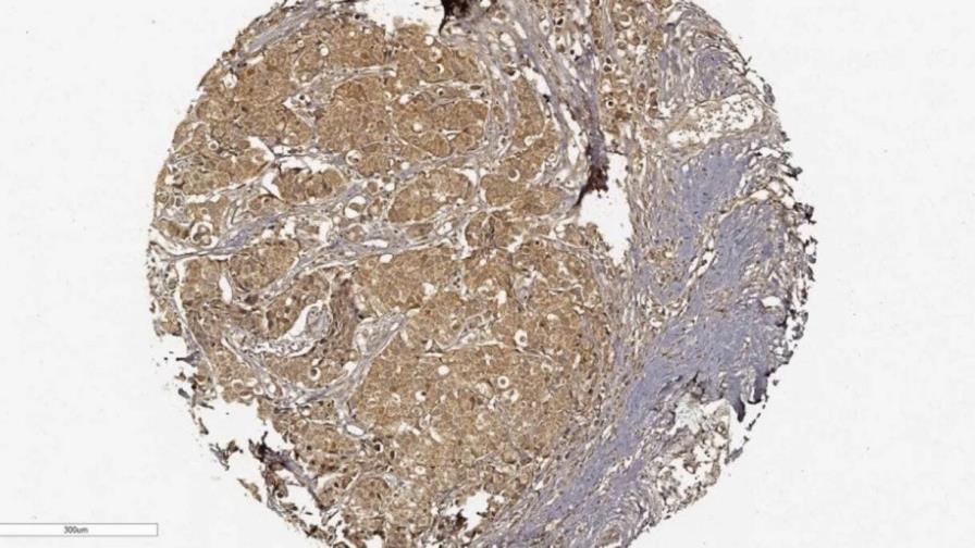 Identifican una nueva diana teraupeútica contra el cáncer de mama