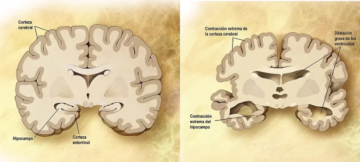 Descubren la posible principal causa del Alzheimer: la clave está en la acumulación de grasa en el cerebro