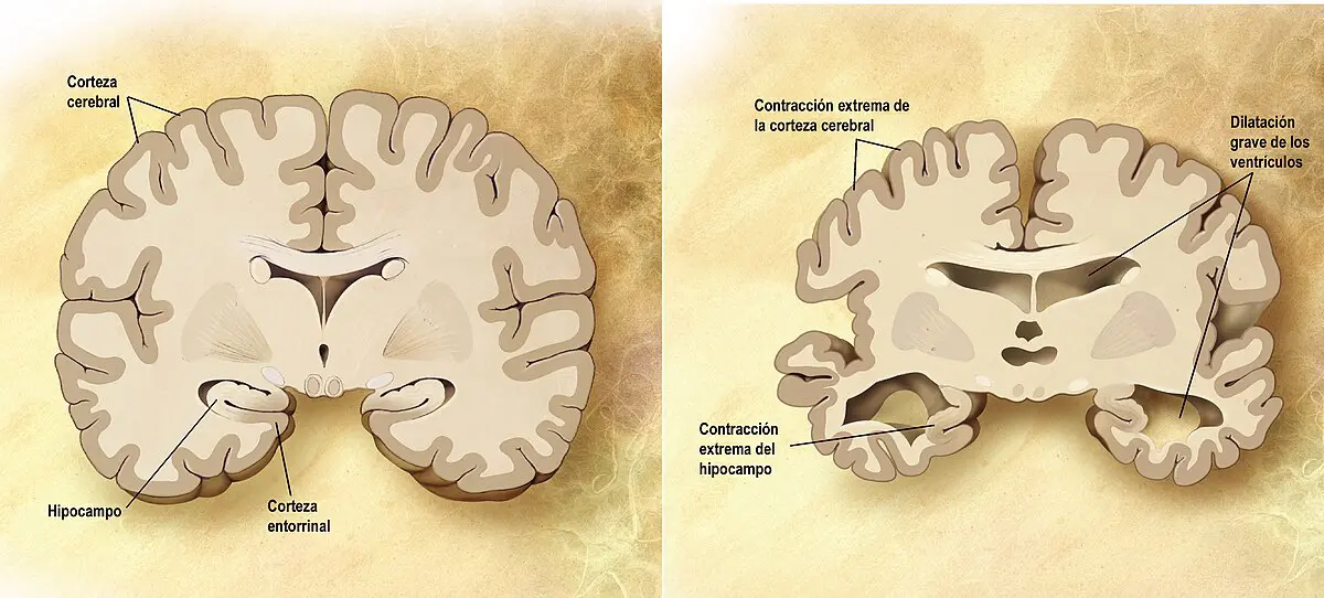 Descubren la posible principal causa del Alzheimer: la clave está en la acumulación de grasa en el cerebro